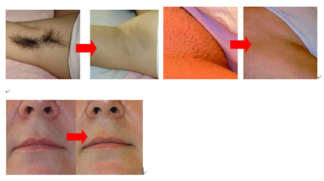 máquina da remoção do cabelo do laser do diodo 808nm para o corpo/cara/underarm