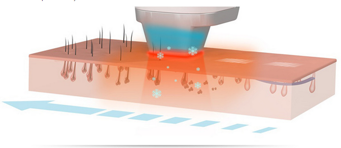 Micro canal de DILAS que refrigera o equipamento 600W da remoção do cabelo do laser de 808 diodos