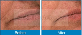 Duração portátil do pulso do CE da máquina da remoção do cabelo do laser do diodo 808nm