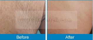 Duração portátil do pulso do CE da máquina da remoção do cabelo do laser do diodo 808nm