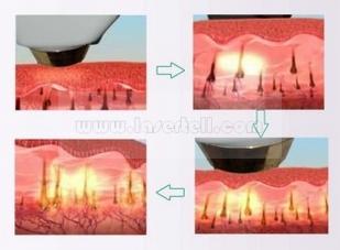 Equipamentos indolores da remoção do cabelo da máquina da remoção do cabelo do laser do diodo da beleza 808nm da depilação