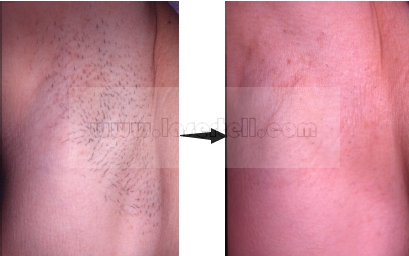 Equipamento da beleza das mulheres SHR IPL para pulsos do rejuvenescimento da pele da remoção do cabelo únicos