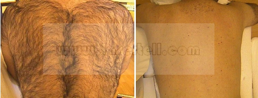 Equipamento da beleza das mulheres SHR IPL para pulsos do rejuvenescimento da pele da remoção do cabelo únicos