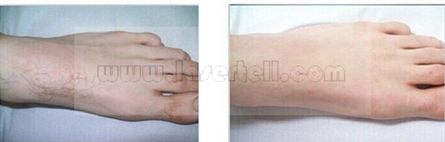 Equipamento da beleza das mulheres SHR IPL para pulsos do rejuvenescimento da pele da remoção do cabelo únicos
