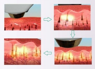 Equipamento da beleza das mulheres SHR IPL para pulsos do rejuvenescimento da pele da remoção do cabelo únicos