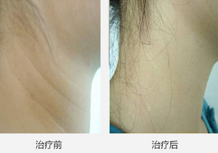 Cabelo portátil indolor do diodo láser 808nm que remove o poder superior da máquina do laser