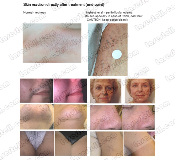 tamanho de ponto AlexMED da remoção 60x65mm do cabelo da máquina do laser do Alexandrite 755nm