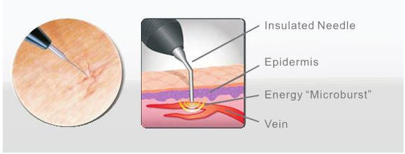Imediatamente máquina do tratamento do laser das veias varicosas da remoção da veia da aranha do resultado/instrumentos cirúrgicos vasculares