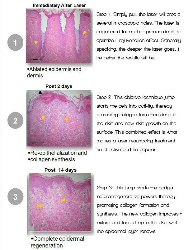 Máquina fracionária do laser do CO2 alto do tubo de Efficienty RF para o rejuvenescimento da pele/remoção do enrugamento