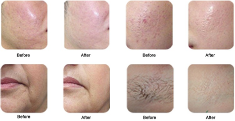 O melhor dispositivo EpiMED- da beleza da remoção do cabelo do preço SHR IPL