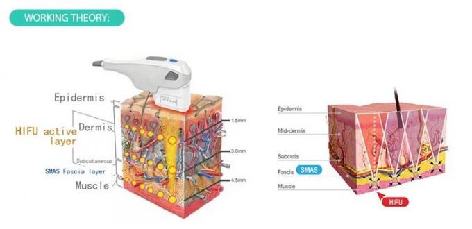A intensidade portátil da máquina 50-60Hz da beleza de Hifu do ultrassom focalizou a aprovação do CE
