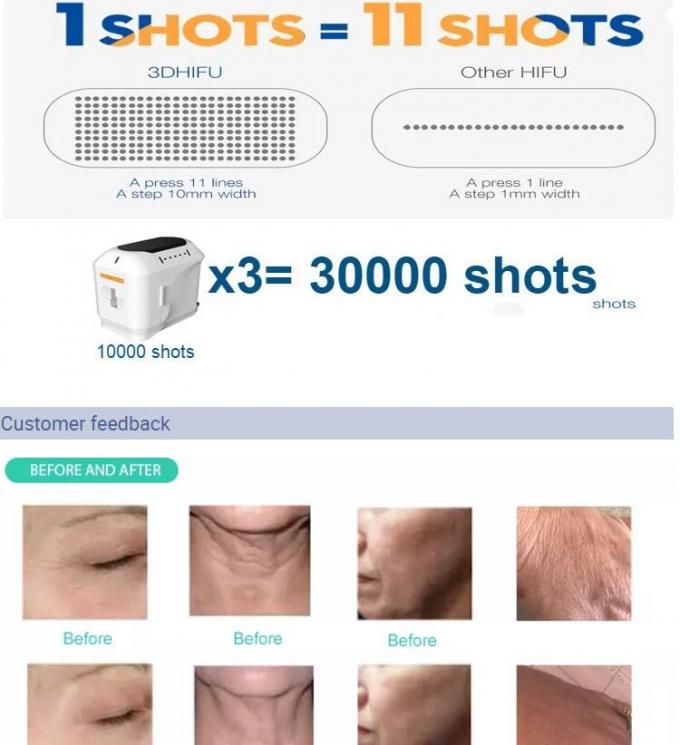 A intensidade portátil da máquina 50-60Hz da beleza de Hifu do ultrassom focalizou a aprovação do CE
