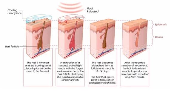 Máquina tratamento/808 indolor da remoção do cabelo do laser do nanômetro da remoção do cabelo 100 J/cm2
